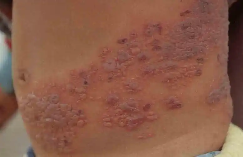 典型的皮肤表现:开始为红斑基底上出现的丘疱疹,并很快发展成水疱,呈