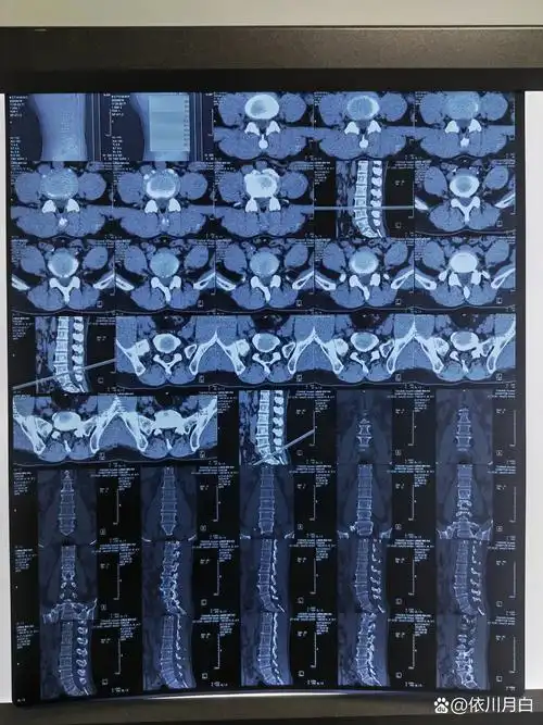 腰5横突肥大伴假关节形成,有的甚至想着要把假关节给切掉