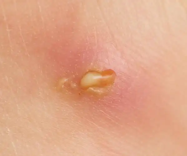 伤口一直流脓怎么办