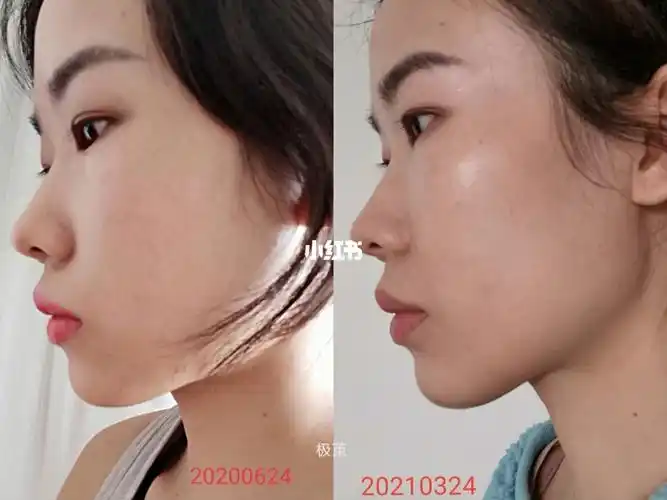 锻炼脸部肌肉和骨骼看看我这9个月的变化