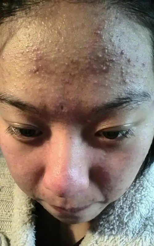 长痘八年,抗战八年. 八年战争都打完了. 先上长痘的照片.