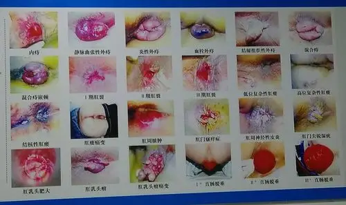 各位有肛门常见病的朋友们,你可以先根据自己的情况,与这张图片对照一