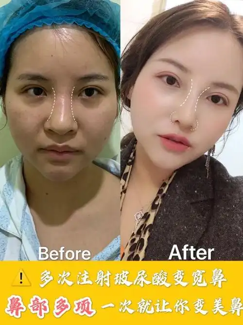 【案例分享】鼻子越来越宽,原来是玻尿酸惹的祸