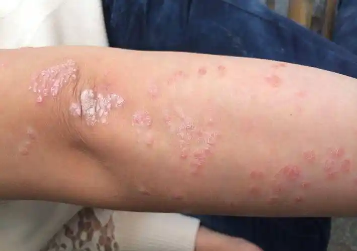 长春肤康医院浅谈:银屑病晚期这些症状很严重,患者一定要重视