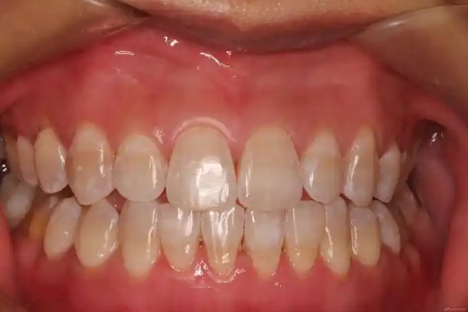 轻度四环素牙诊室漂白一例