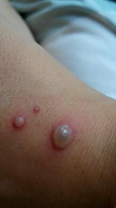 小孩水痘症状图片 (60)_有来医生