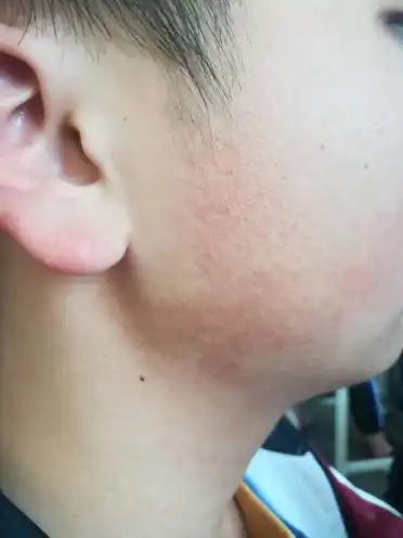 两腮冬天发红夏天颜色就像死皮一样,但不疼不痒
