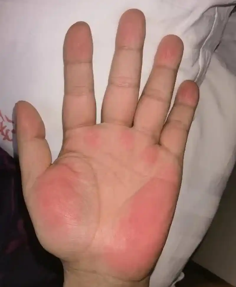 图中这就是肝掌,很明显的就能看出,手掌的大小鱼际处发红,有的患者
