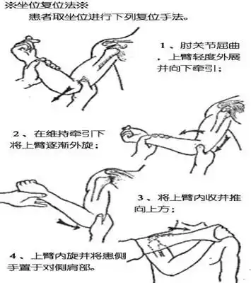 【宝宝脱臼复位手法图解】小孩脱臼怎么复位图片