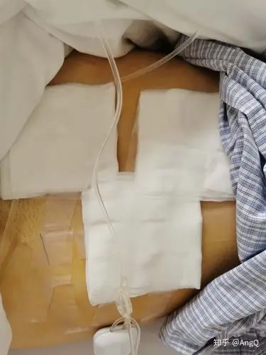 阑尾周围脓肿阑尾炎腹腔镜手术经验贴别再说阑尾炎是小手术了