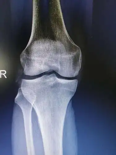 eras快速康复之髌骨骨折闭合复位浅谈