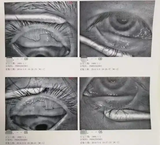 眼干被误诊为结膜炎2年多80后美女睑板腺几乎全部萎缩