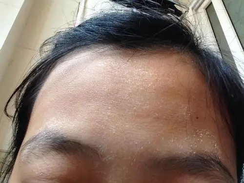 小孩额头褪皮,是在变白吗? 怎么治啊