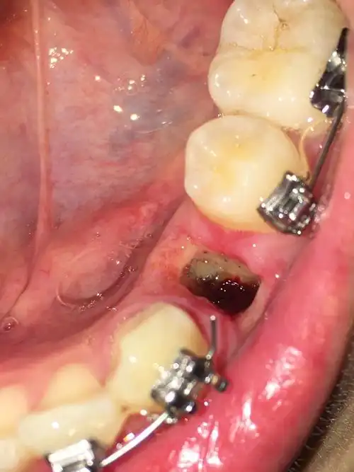 有图慎点反复干槽症四号牙有没有懂的朋友进来解答一下呀