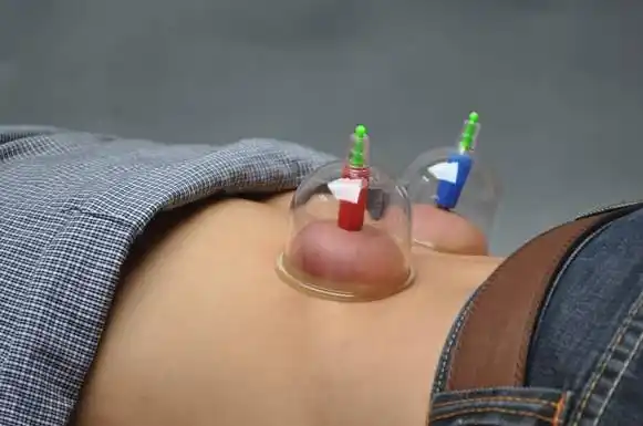 腰腿痛时,这样拔罐简单有神效