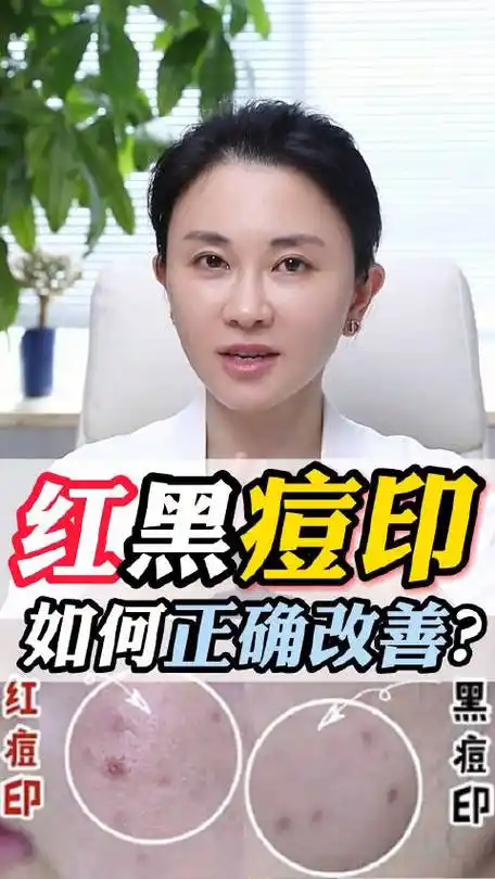 皮肤管理##祛痘##痘痘,痘印,痘坑,痘疤修复##痘痘##皮肤医生张琳琳