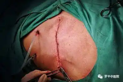 其次早期乳腺癌手术可保乳,单纯切除包块,或者仅切除腺体(保留乳头和