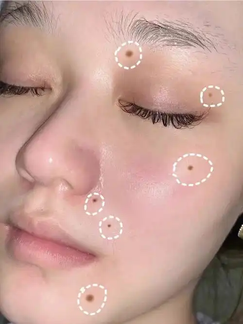 还是选择了激光点痣,主要是看很多药水的都长出来了过程还是很快的,记