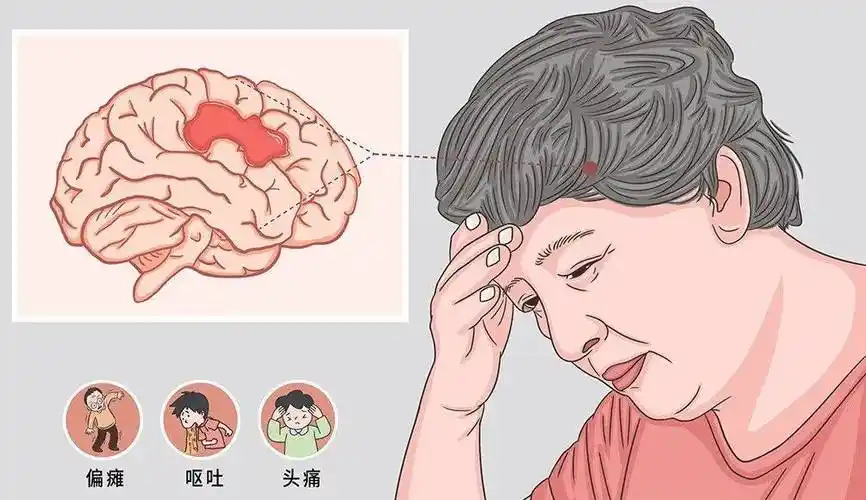 【常见老年疾病科普】脑卒中患者的临床表现