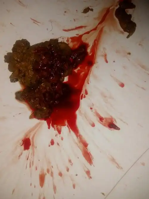 大便中便血,大便不成形.不疼不痒.没有任何症状.今天第三天.