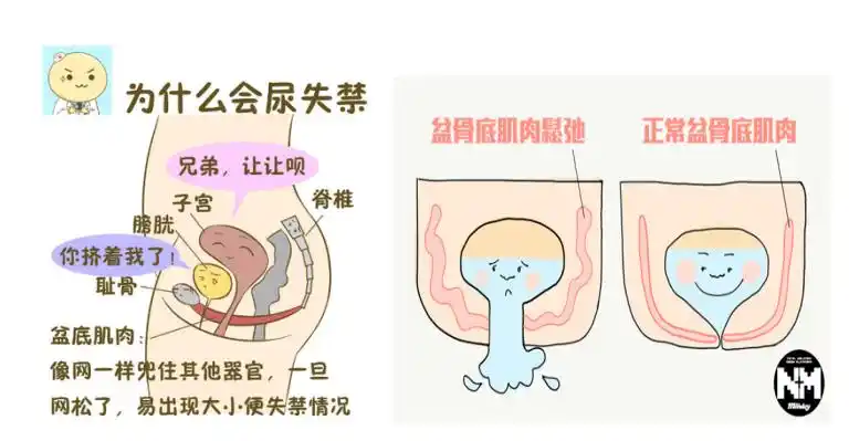 健康生活|不能被忽视的女性尿失禁