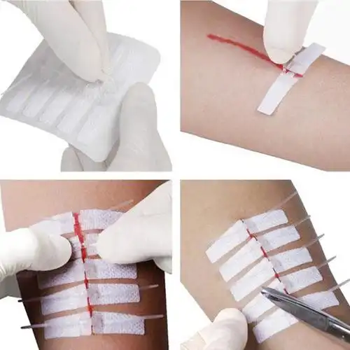 户外免缝胶带伤口快速缝合拉链式创可贴无菌紧急伤口闭合粘合绷带
