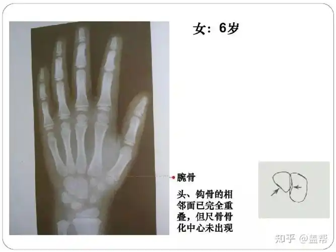 骨龄几岁还能长高吗女孩篇