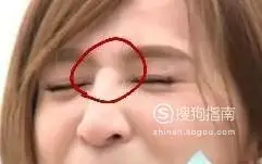 山根有横纹怎么去除