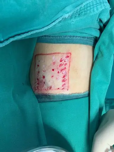 12.7植皮后换药 2019.12.15换药 2019.12.21换药痊愈出院