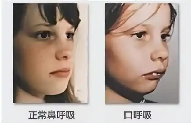 睡眠口呼吸有什么危害?