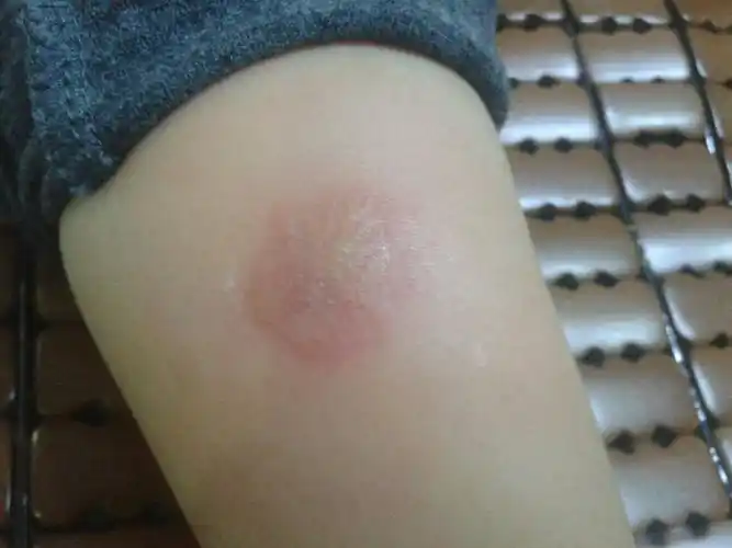 推荐回答 病情分析:   你好,这种情况啊,看着像是真菌感染引起的.