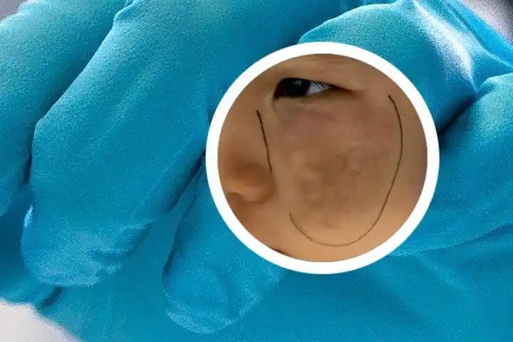 新生儿青色胎记图片