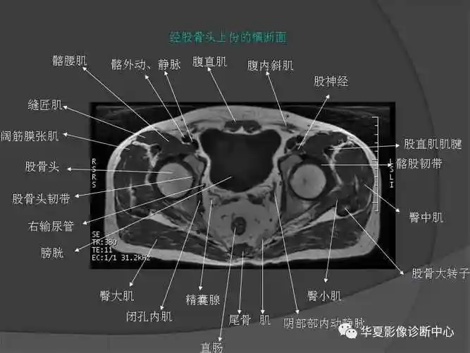 盆腔mri断层解剖你掌握了吗
