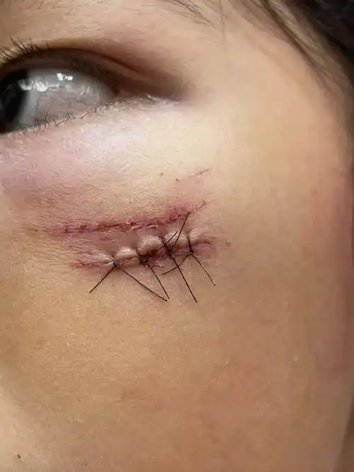 昨天外伤后在惠州公立医院的美容科进行了外科美容缝合