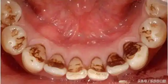 作为老烟枪满口黑牙该怎么办