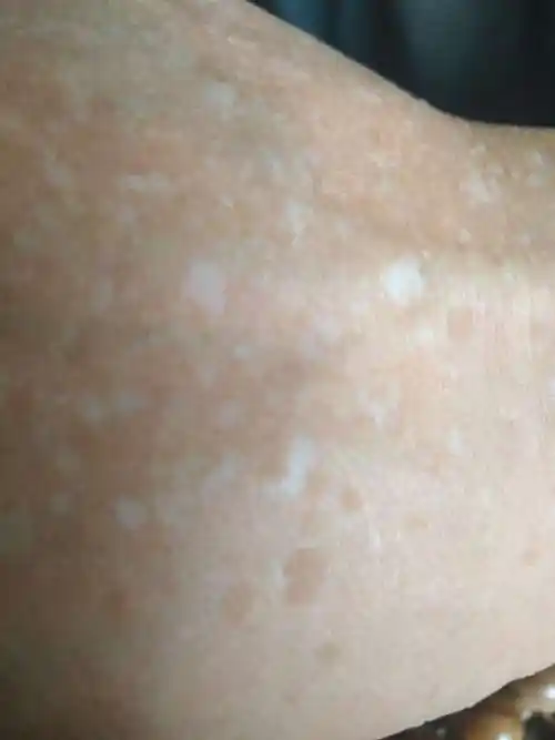 身上多年的白斑是什么疾病