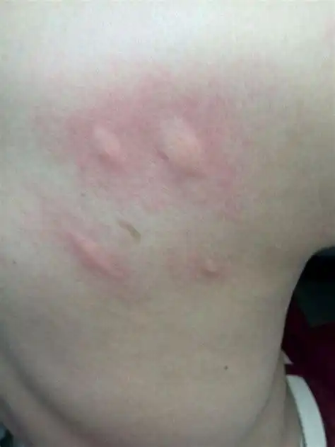 被蚂蚁咬了皮肤过敏被蚂蚁咬后全身过敏怎么改善2022已更新今日动态