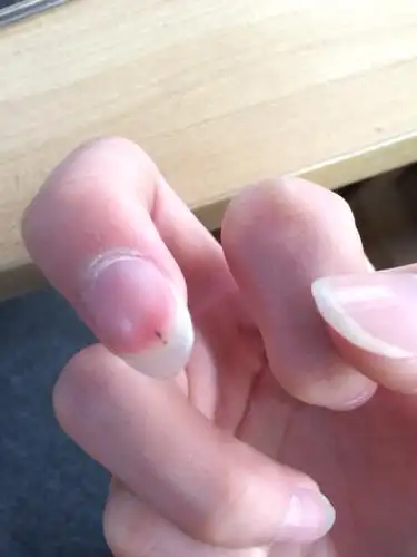 指甲上有这种黑线是什么情况?