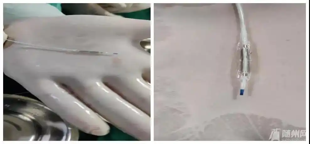 左为切割球囊扩张前的样子,右为切割球囊扩张后的样子△左为药物