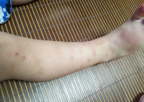 宝妈们有没有什么方法,宝宝身上被蚊子咬的不成样,都结疤了