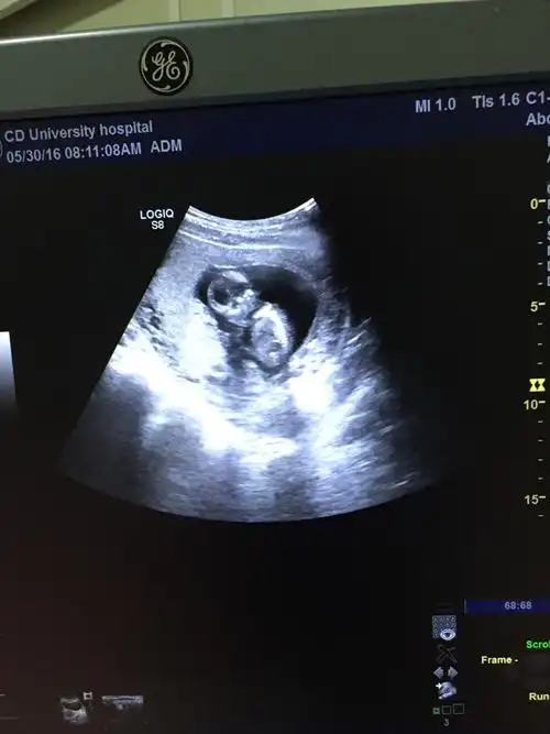 孕期14周,胎儿b超图片,麻烦帮忙看一下是否正常