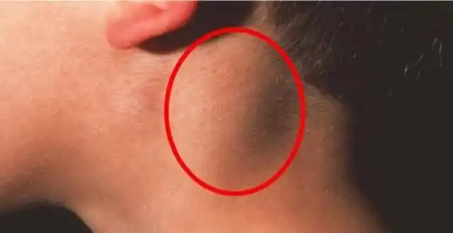 小伙颈部鼓包不消,检查8次才知道是淋巴结核,有这些表现的患者注意