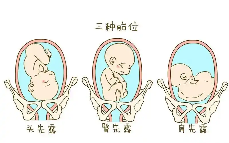 一味的坚持并没有太大的意义,因为这个时候胎位已经很难再转过来了