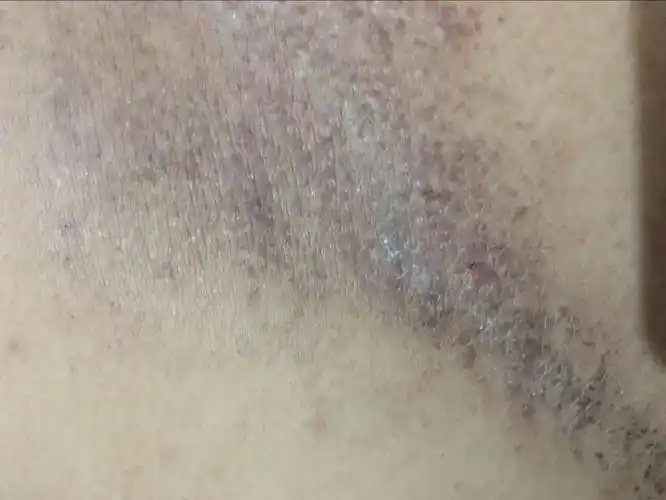 背部皮肤以前经常挠,挠到后面开始变黑,一流汗或是吃辣,喝酒就