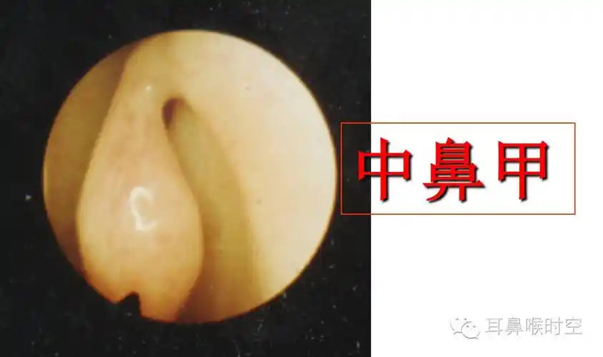 模式图窦口鼻道复合体以筛漏斗为中心的邻近区域结构,包括:中鼻甲  钩