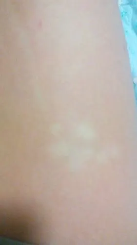 腿上这几个白点好几年了.不痛不痒没任何症状