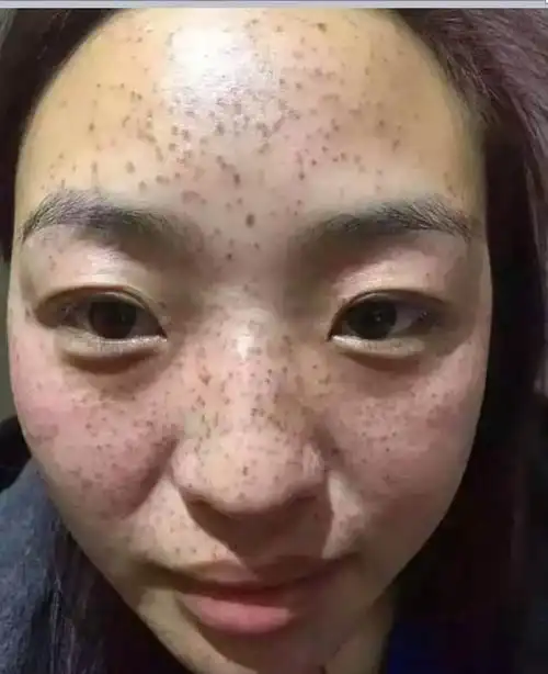 脸上长斑:表示该部位器官长期慢性耗损形成的慢性疾病(3-5年形成)