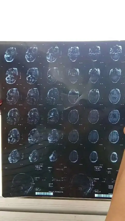 这我也看不懂买票回家找我妈去毕竟也是医生#ct片子怎么看结石 - 抖音