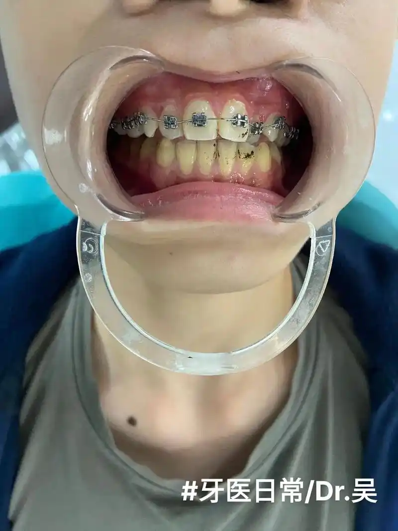 初中生上颌牙齿排列不整齐,矫正器第一天.#正畸 #牙科  - 抖音