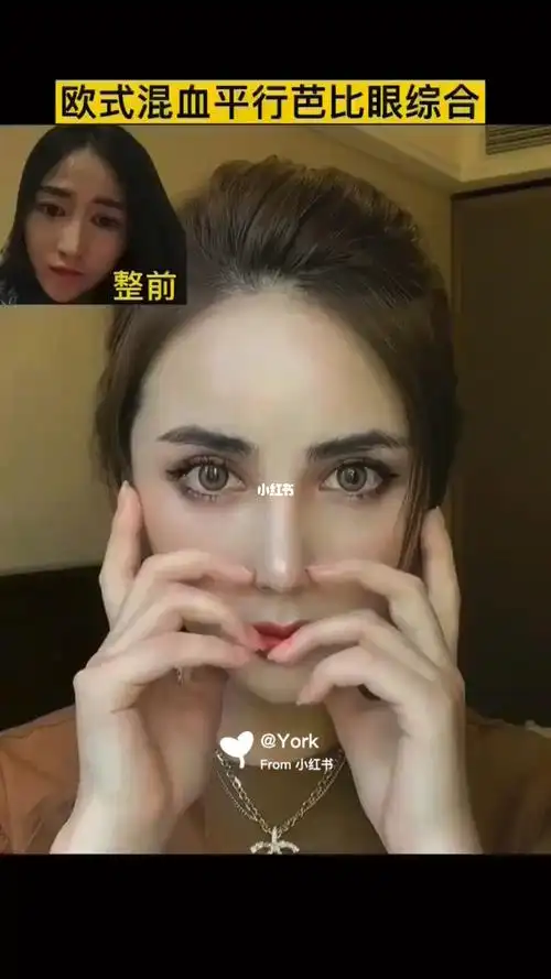 欧式混血平行芭比眼综合